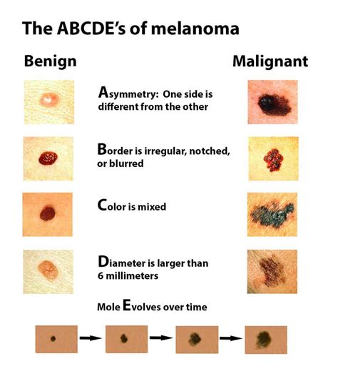 how to identify melanoma skin cancer